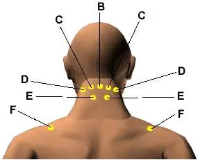 Acupuncture for Neck and Shoulder Pain: Is It Any Better Than Conventional Treatment?